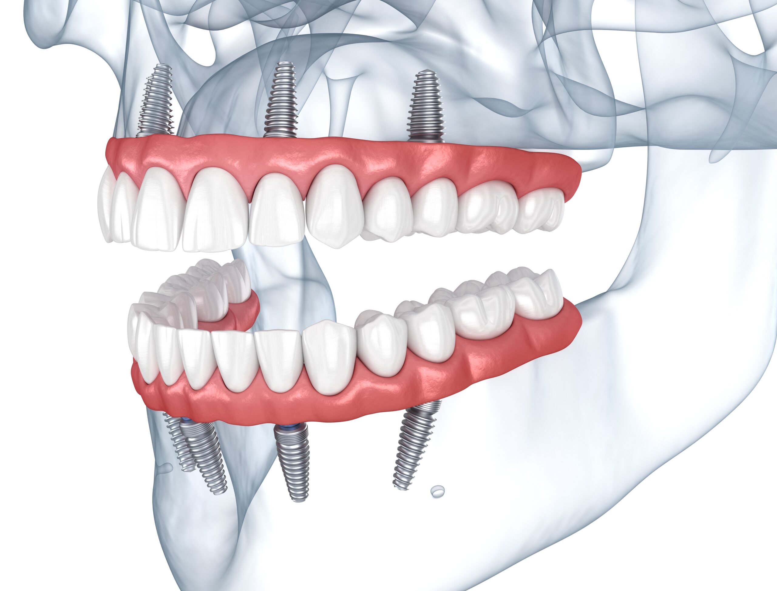 Dental X-ray illustration showing teeth and gum alignment at Oak Mountain Denture and Implant Center
