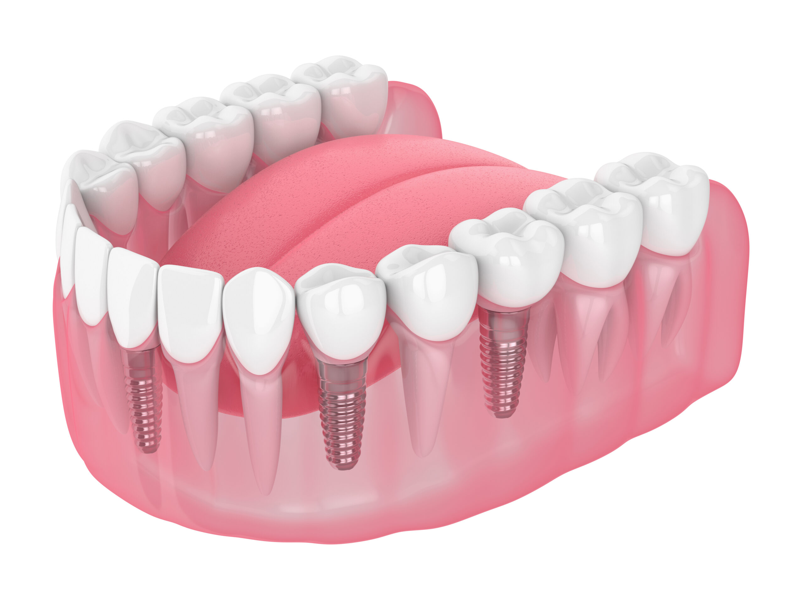 3D Image of multiple dental implants - Oak Mountain Dentures and Implant Center.