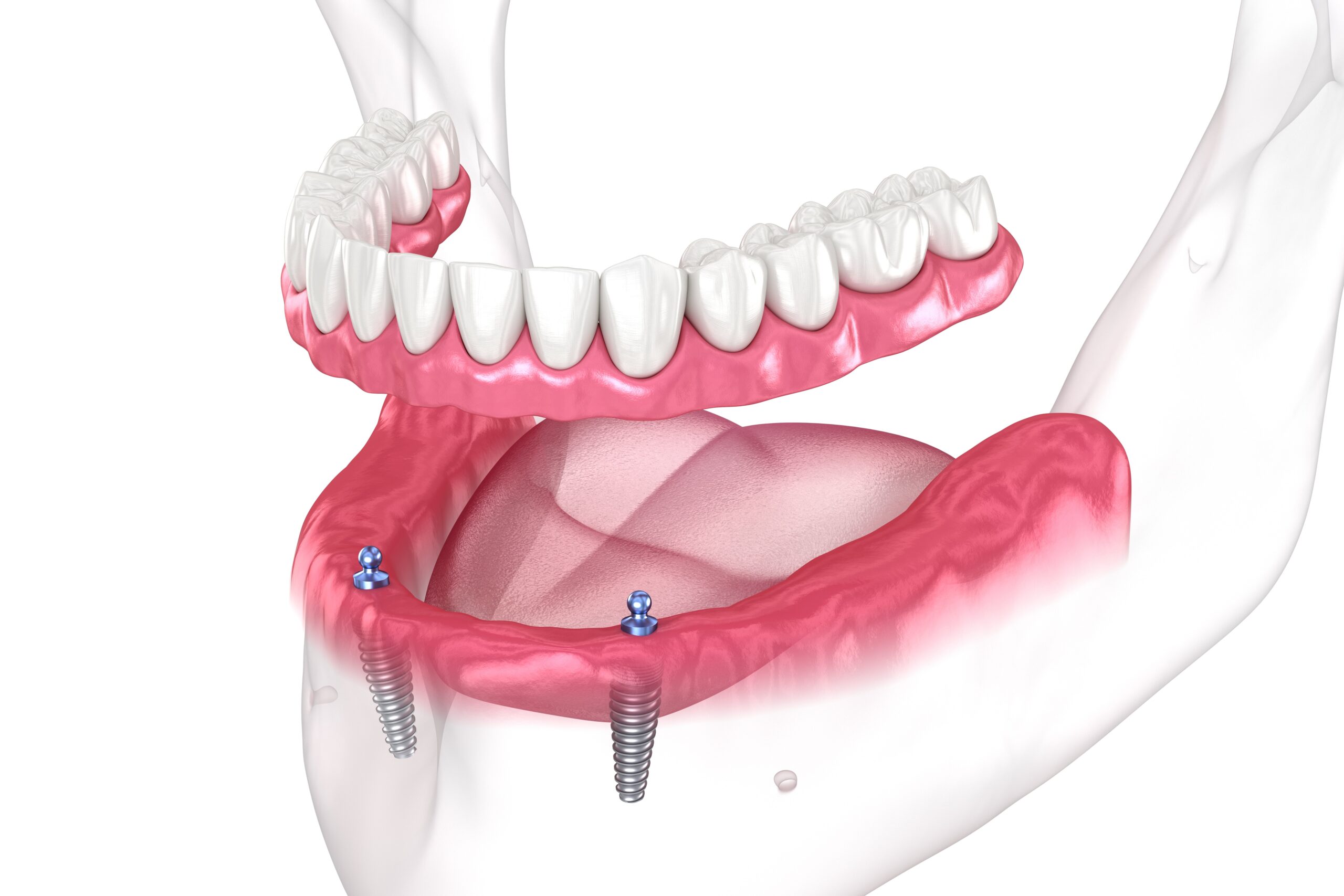 Infographics showing implant supported Snap in Dentures - Oak Mountain Denture and Implant Center.