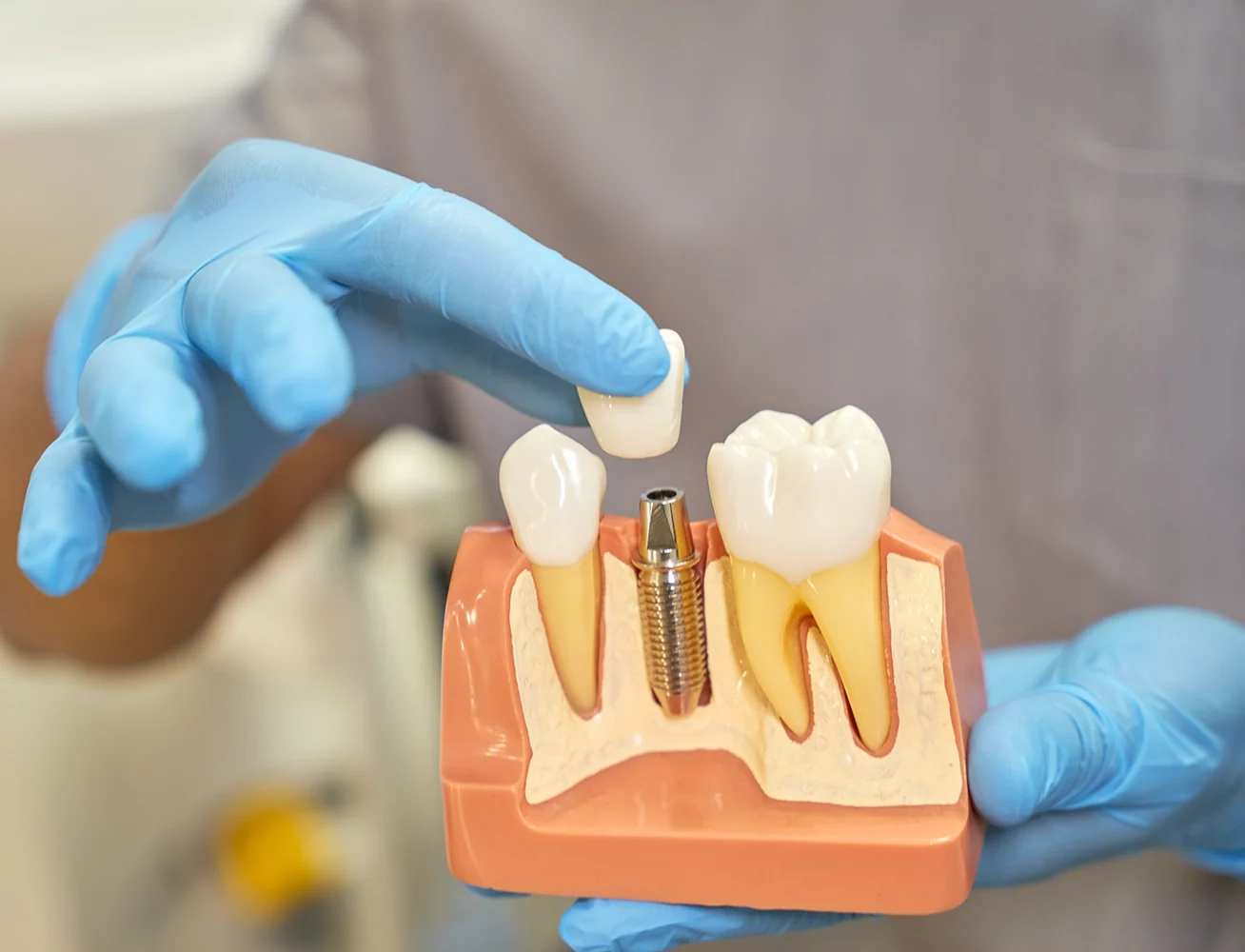 Model of a Dental Implant - Oak Mountain Denture and Implant Center