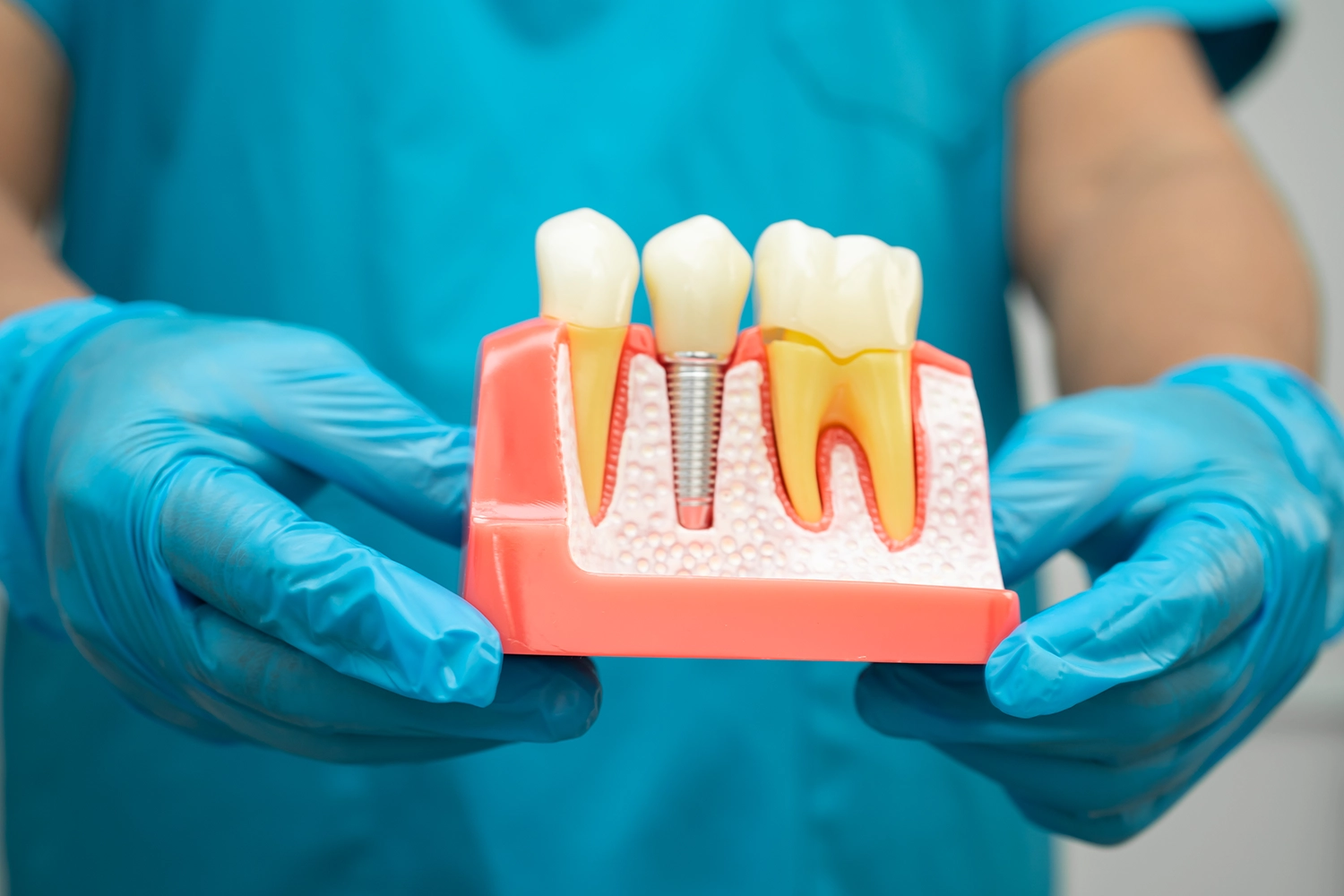 Dentist wearing blue gloves holding a dental model that shows a titanium implant between two natural teeth