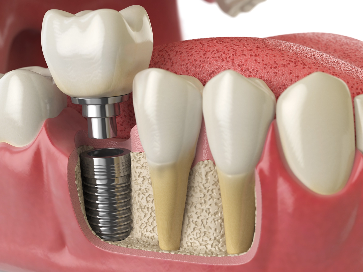 Dental implant model showing titanium post and gum structure
