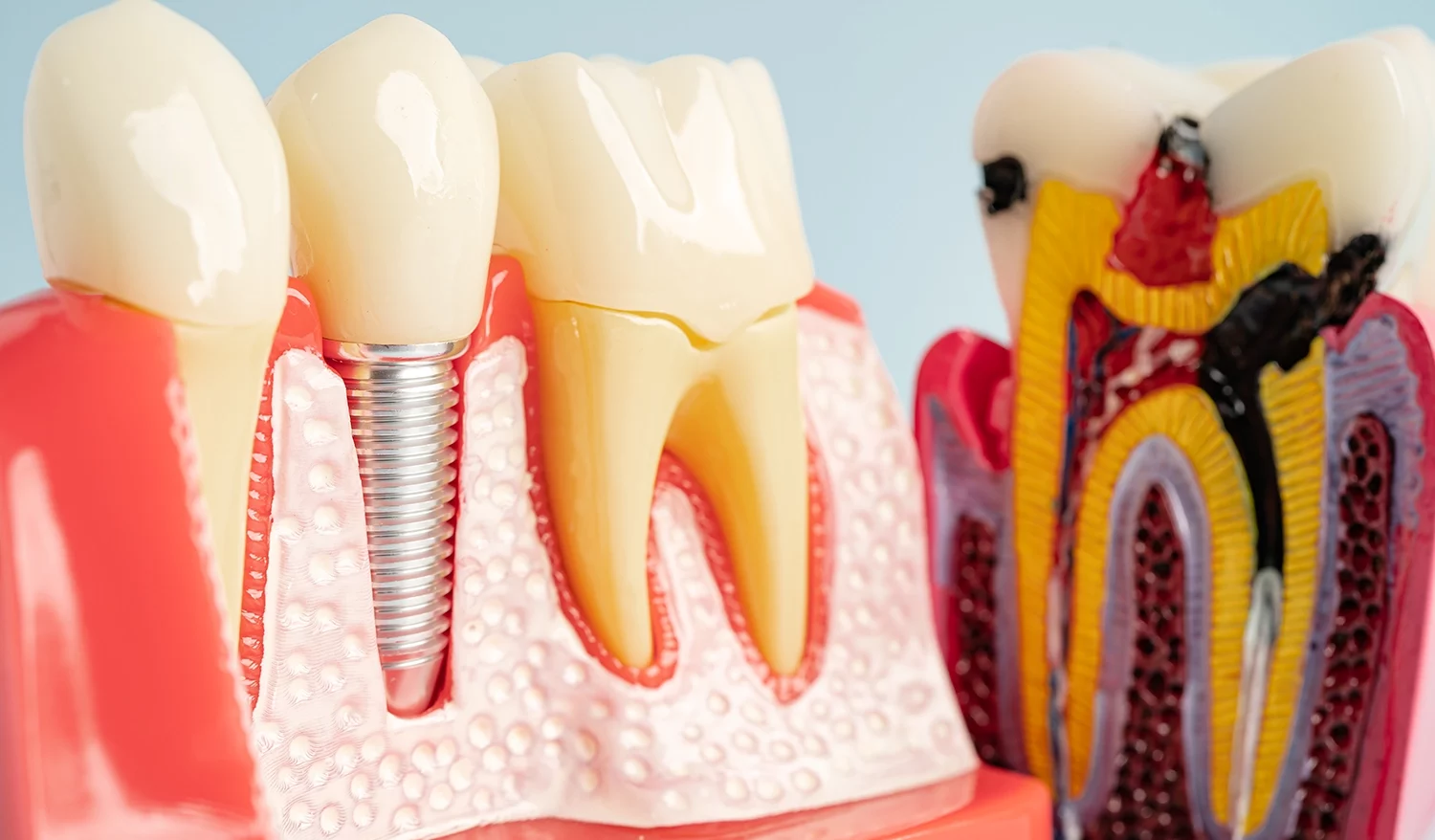 Model of a single implant and crown next to the model of a cross section of tooth.