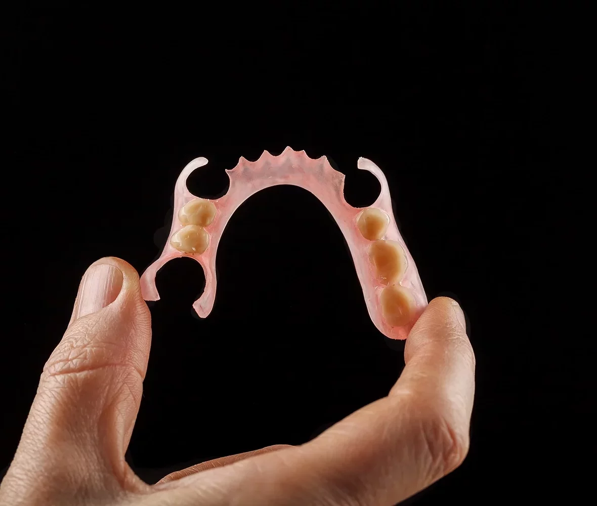 Removable partial denture model showing metal framework