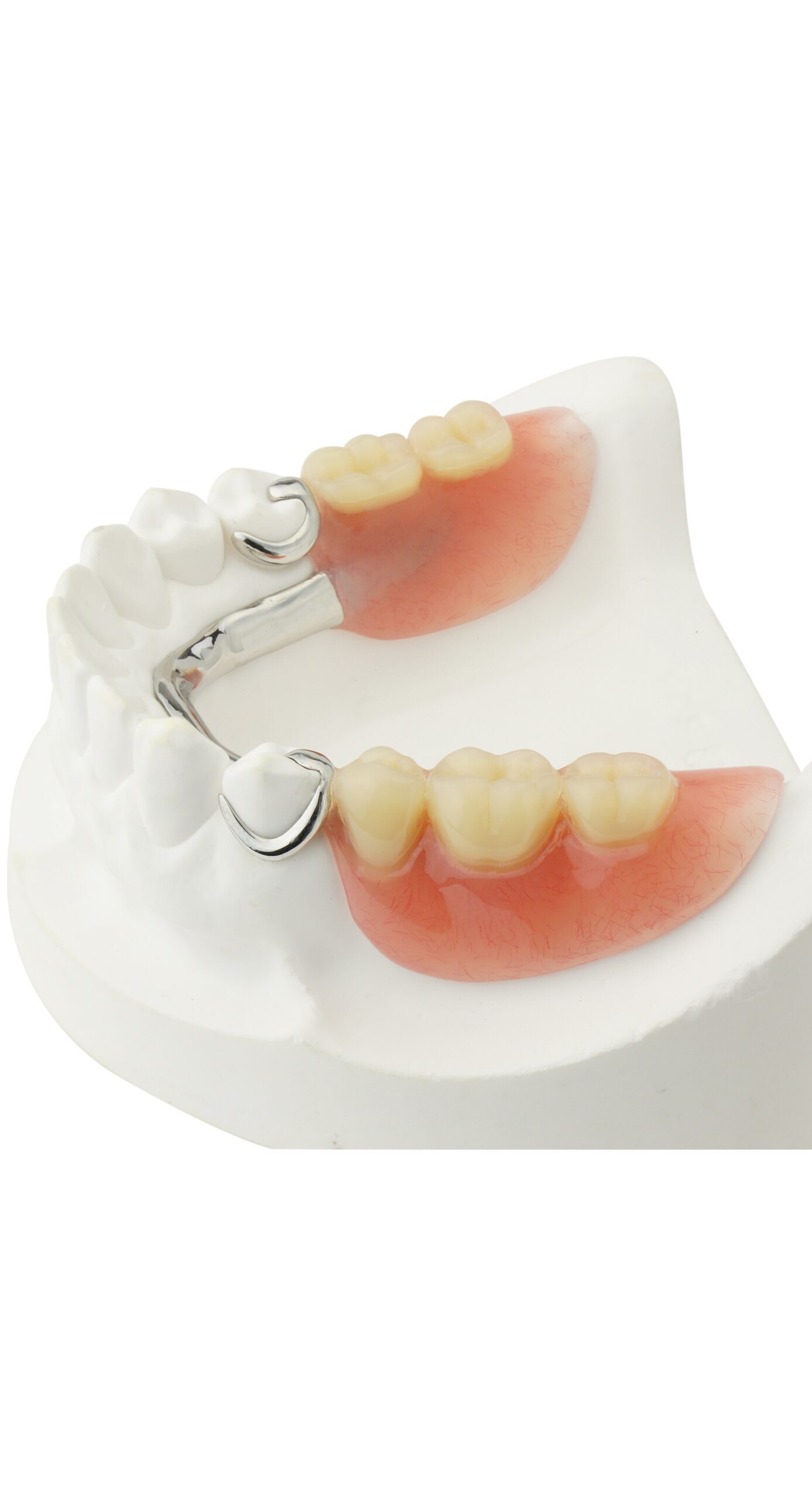 Cast metal partial denture with beautiful replacement teeth